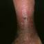 104. Venous Eczema on Legs Pictures