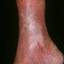 107. Venous Eczema on Legs Pictures