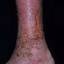 109. Venous Eczema on Legs Pictures