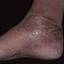 11. Venous Eczema on Legs Pictures