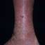 110. Venous Eczema on Legs Pictures