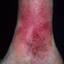 111. Venous Eczema on Legs Pictures