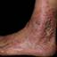 112. Venous Eczema on Legs Pictures