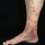 113. Venous Eczema on Legs Pictures