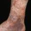 114. Venous Eczema on Legs Pictures