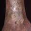 115. Venous Eczema on Legs Pictures