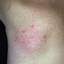 118. Venous Eczema on Legs Pictures