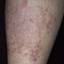 119. Venous Eczema on Legs Pictures