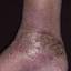12. Venous Eczema on Legs Pictures