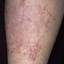 120. Venous Eczema on Legs Pictures
