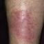 121. Venous Eczema on Legs Pictures