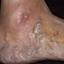 123. Venous Eczema on Legs Pictures