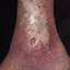 124. Venous Eczema on Legs Pictures