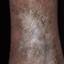 125. Venous Eczema on Legs Pictures