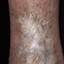 126. Venous Eczema on Legs Pictures