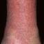 127. Venous Eczema on Legs Pictures