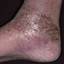 13. Venous Eczema on Legs Pictures