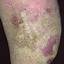 132. Venous Eczema on Legs Pictures