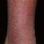138. Venous Eczema on Legs Pictures