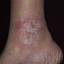 139. Venous Eczema on Legs Pictures