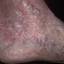 14. Venous Eczema on Legs Pictures