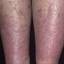140. Venous Eczema on Legs Pictures