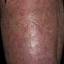 141. Venous Eczema on Legs Pictures