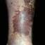 146. Venous Eczema on Legs Pictures