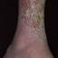 147. Venous Eczema on Legs Pictures