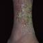 148. Venous Eczema on Legs Pictures