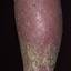 149. Venous Eczema on Legs Pictures