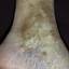 15. Venous Eczema on Legs Pictures