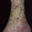 150. Venous Eczema on Legs Pictures