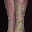 151. Venous Eczema on Legs Pictures
