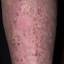 152. Venous Eczema on Legs Pictures
