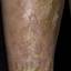 153. Venous Eczema on Legs Pictures