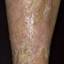 154. Venous Eczema on Legs Pictures
