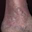 155. Venous Eczema on Legs Pictures