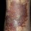 156. Venous Eczema on Legs Pictures