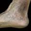 157. Venous Eczema on Legs Pictures