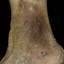 158. Venous Eczema on Legs Pictures