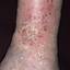 159. Venous Eczema on Legs Pictures