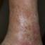 16. Venous Eczema on Legs Pictures