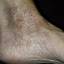 160. Venous Eczema on Legs Pictures