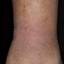161. Venous Eczema on Legs Pictures