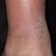 162. Venous Eczema on Legs Pictures