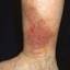 163. Venous Eczema on Legs Pictures