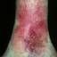 164. Venous Eczema on Legs Pictures