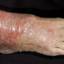 165. Venous Eczema on Legs Pictures