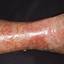 168. Venous Eczema on Legs Pictures